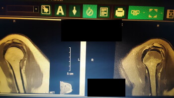 Moderna COVID-19 injection photo #1